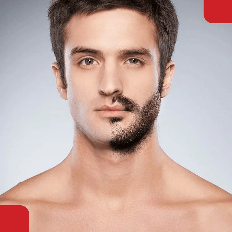 beard transplant