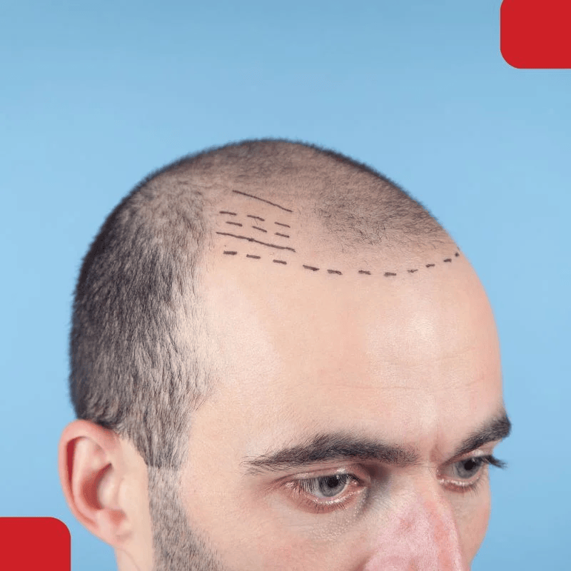 fue hair transplant