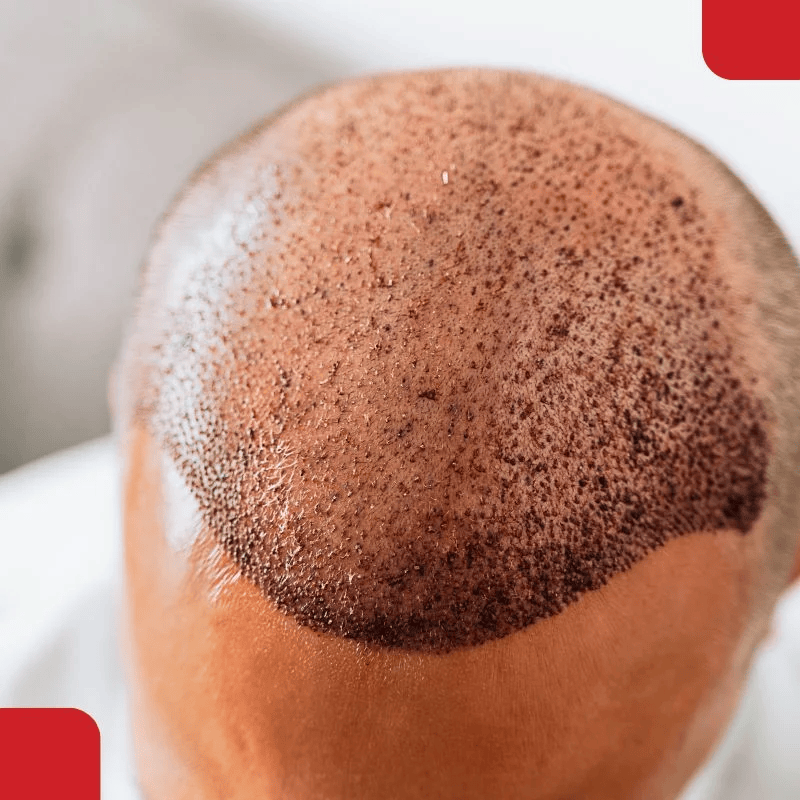 Basic Fue Hair Transplant