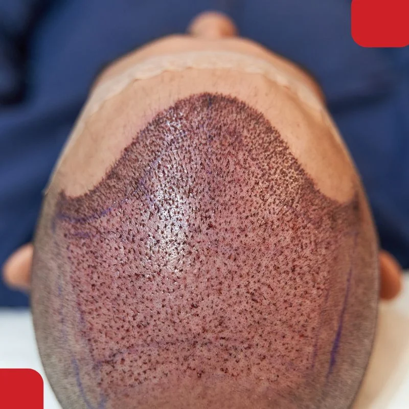 mesothetitanium fue hair transplantrapy 