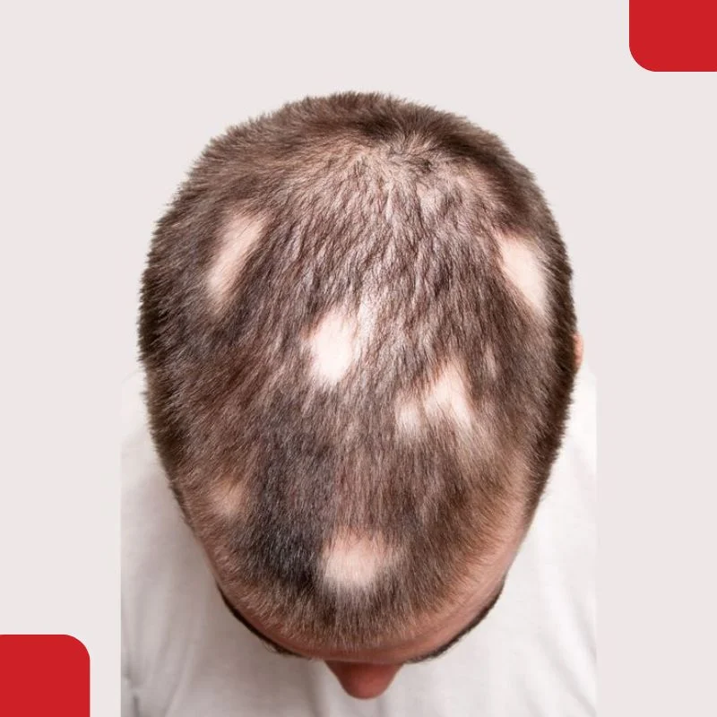 partial alopecia