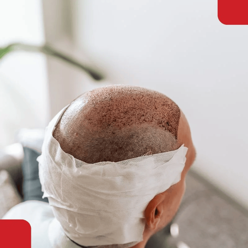 percutaneous fue (1) (1)