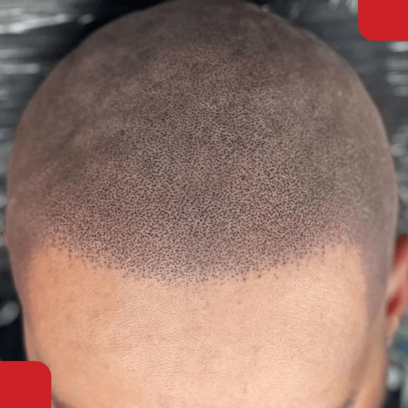 scalp micropigmentation